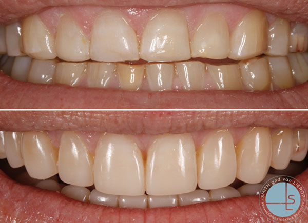 Dental Bonding  Smith and Van Lierop Dentistry
