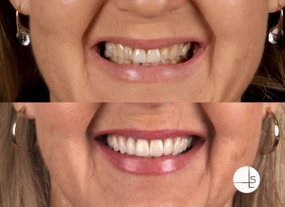 invisalign invisalign