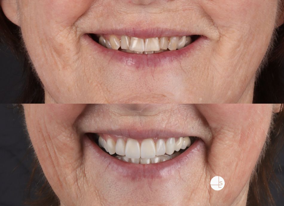 invisalign invisalign