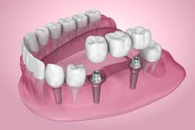 Implant-Supported Bridge