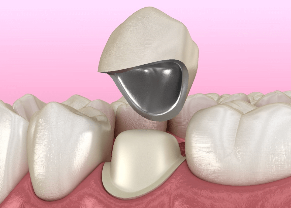 Resin Crowns
