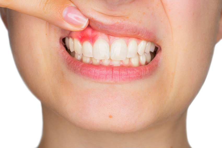 Gum Disease Header