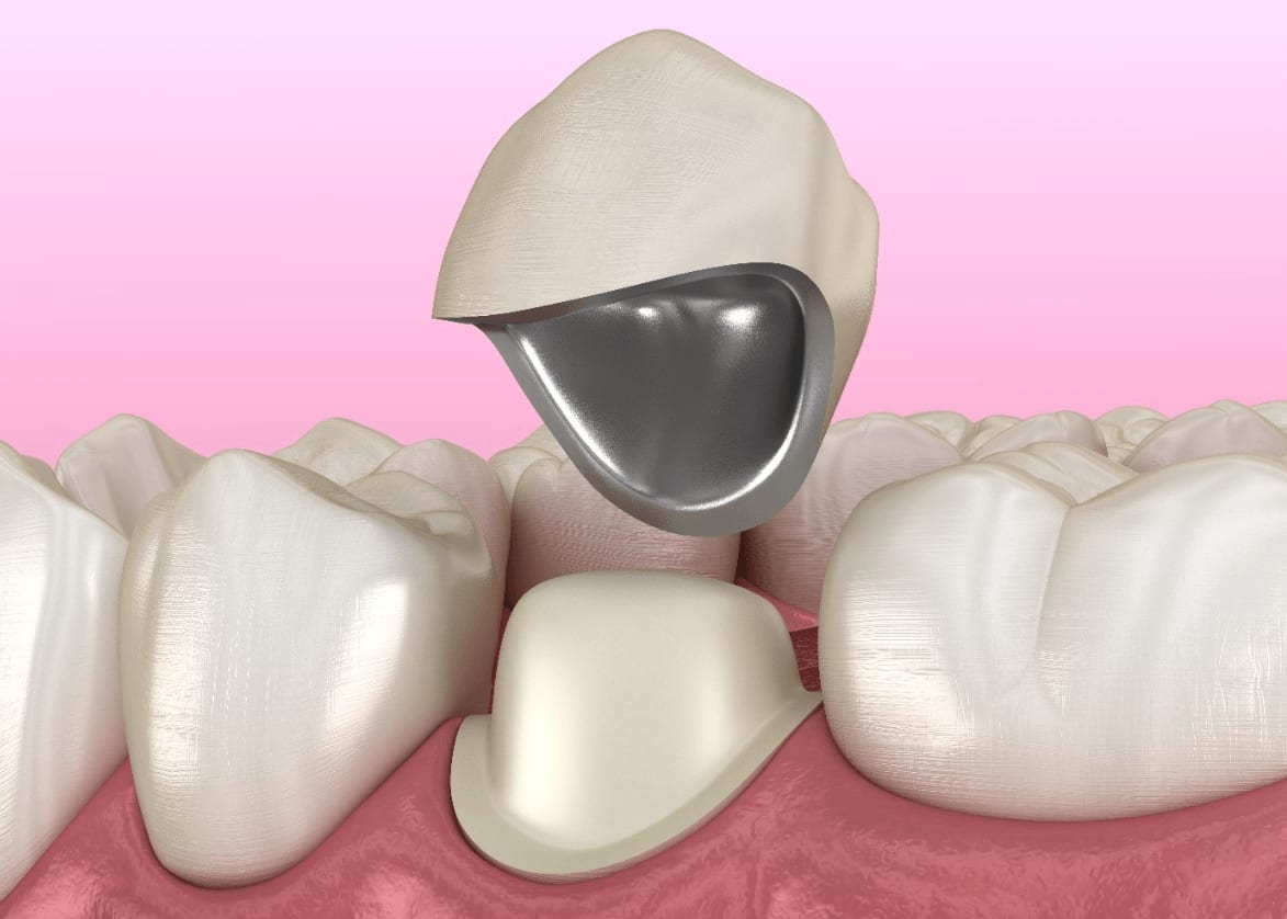 Resin Crowns
