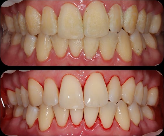 EMS before and after 3