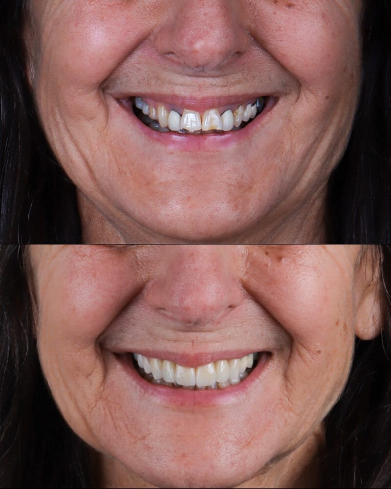 SVL before after 20