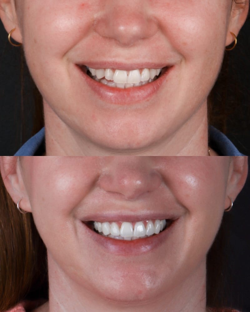 SVL before after 24