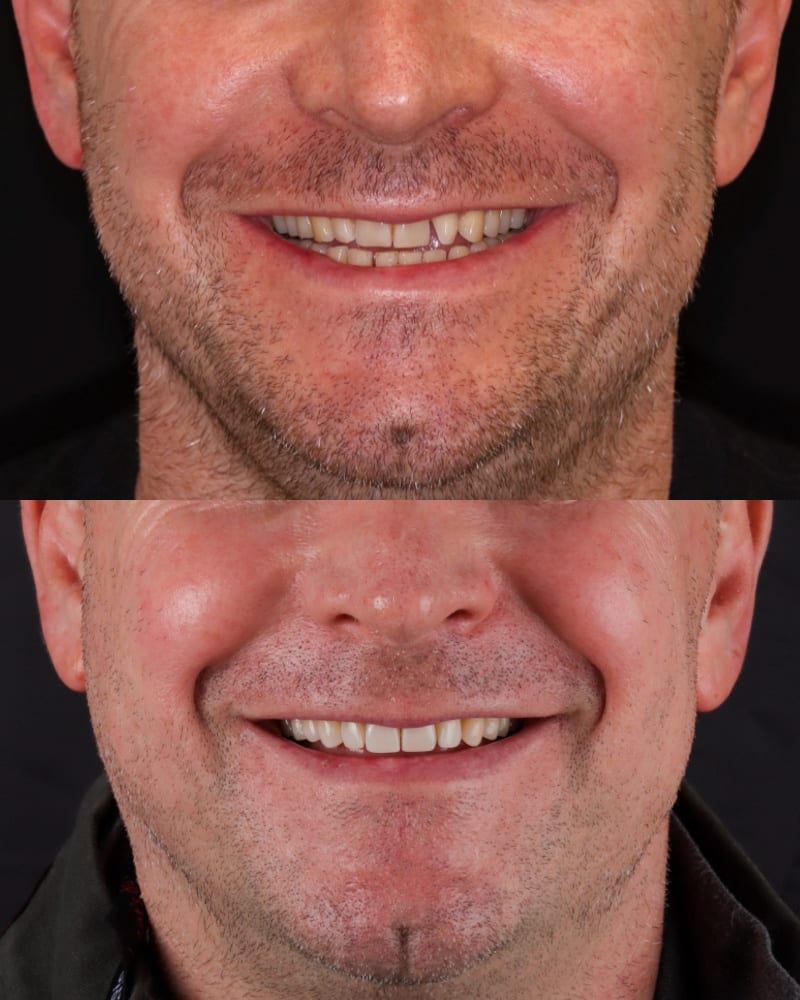 SVL before after 25