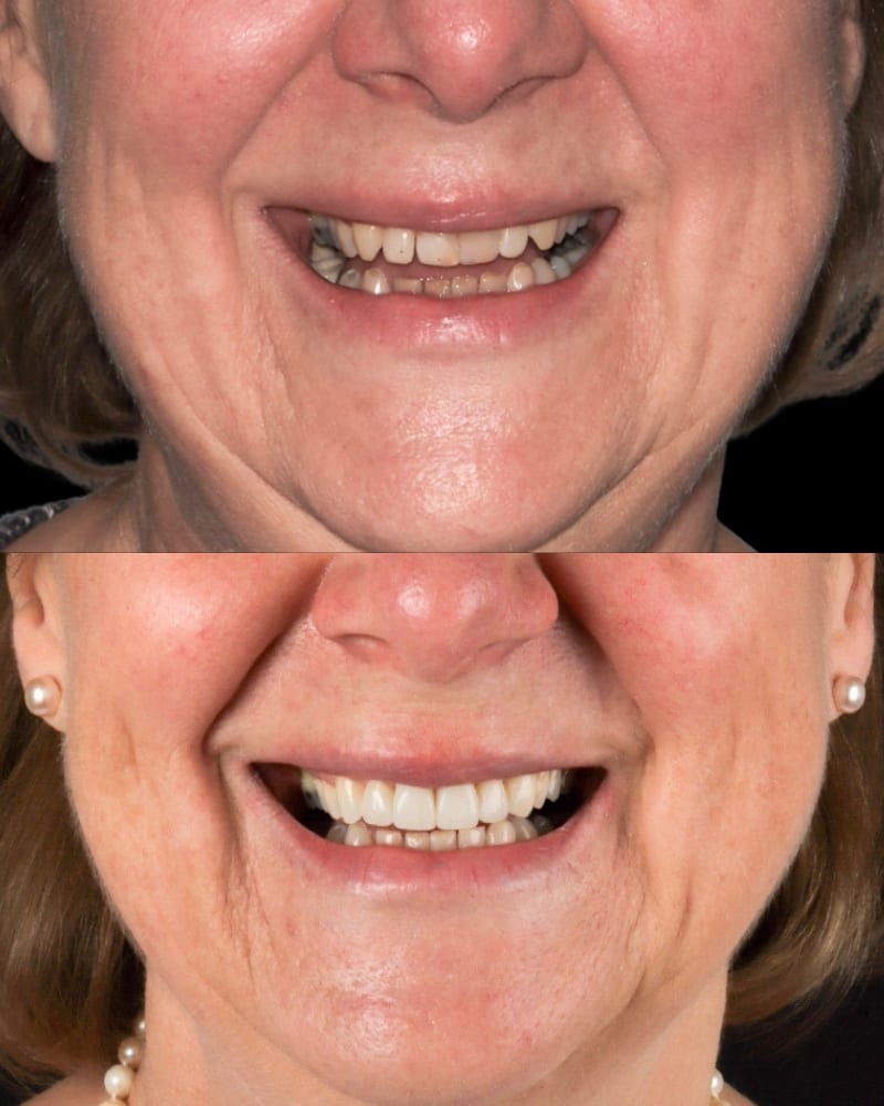 SVL before after 28