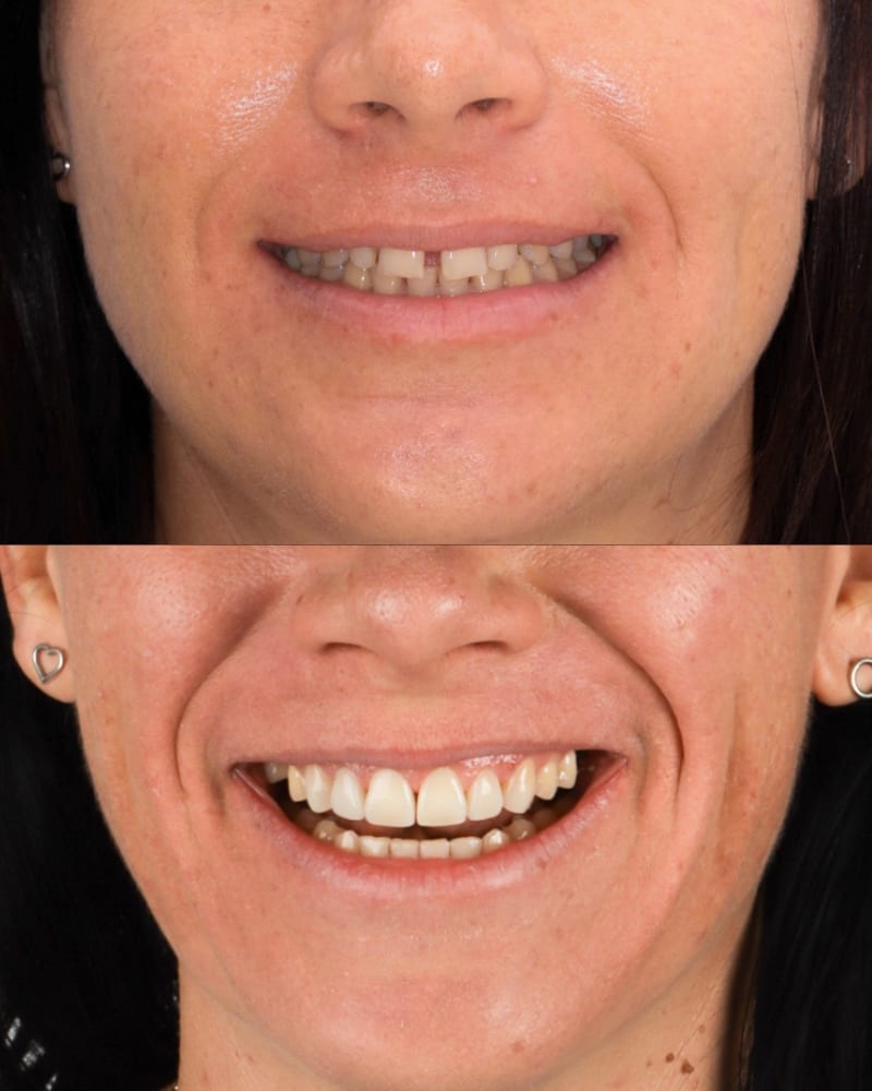 SVL before after 30