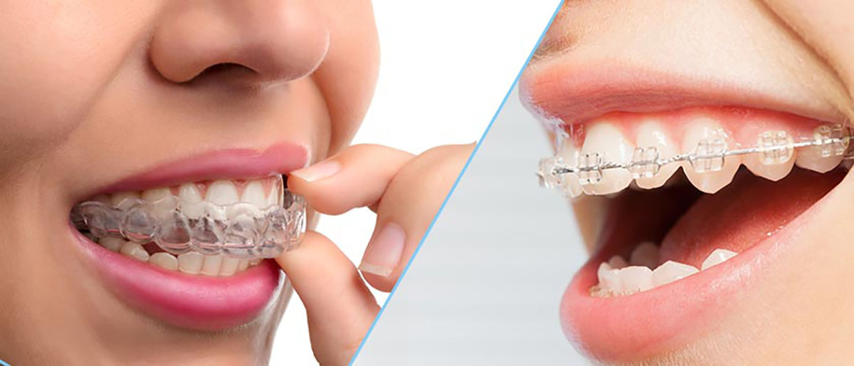orthodontics invisalign slider