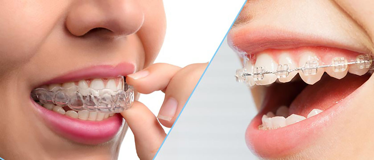 Orthodontics Smith And Van Lierop Dentistry