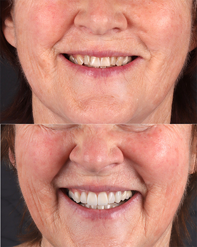 Veneers Smile Makeover 4