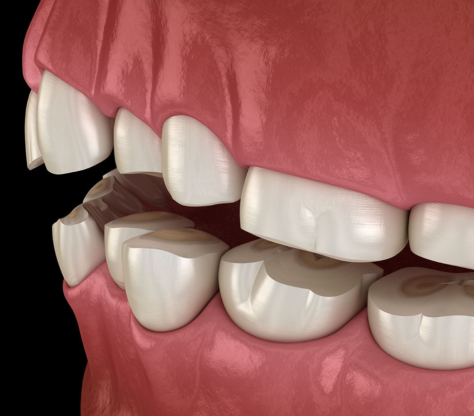 invisalign invisalign
