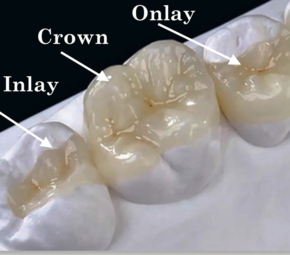 White Composite fillings White fillings