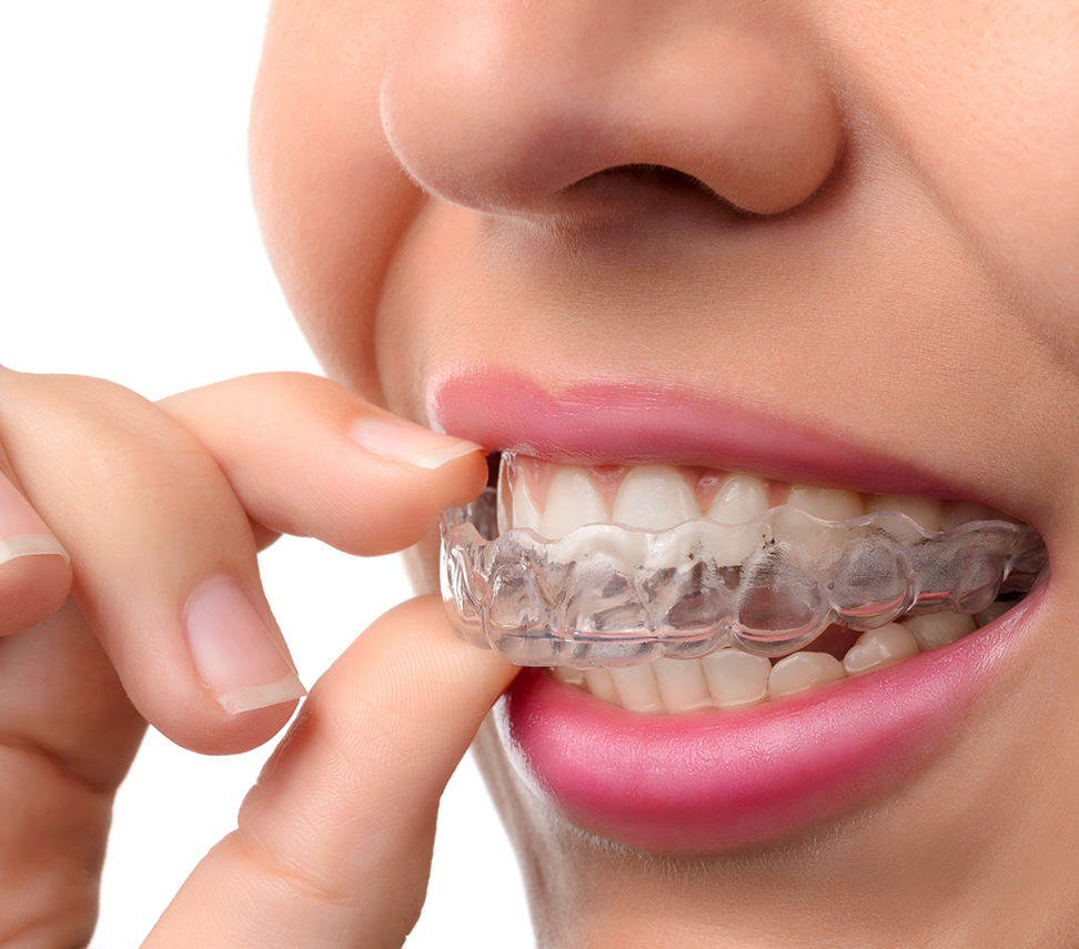 invisalign invisalign