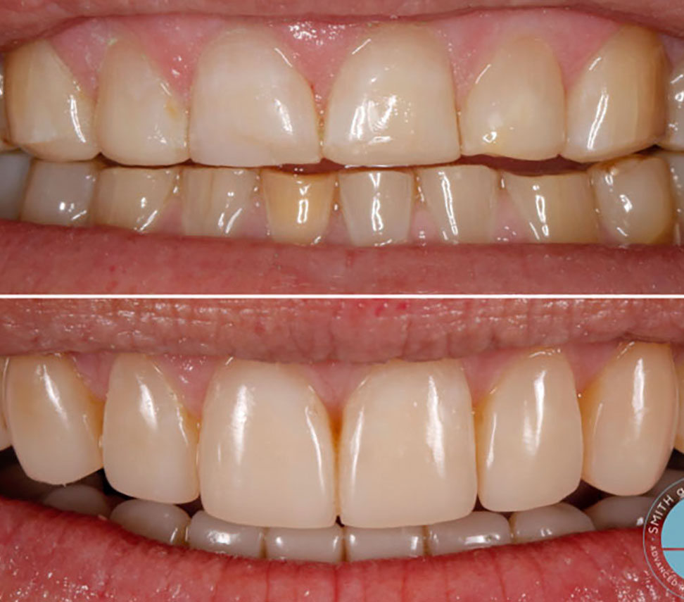 ceramic restorations