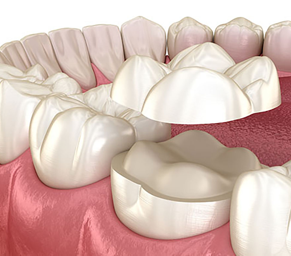 ceramic restorations