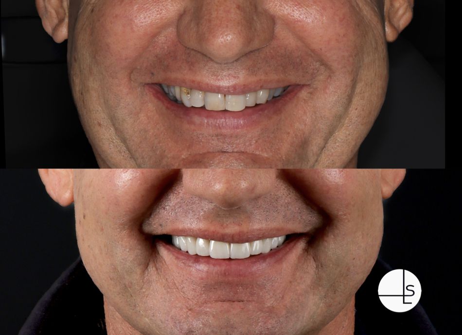 Veneers Dental veneers