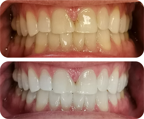 Whitening Before and After 1