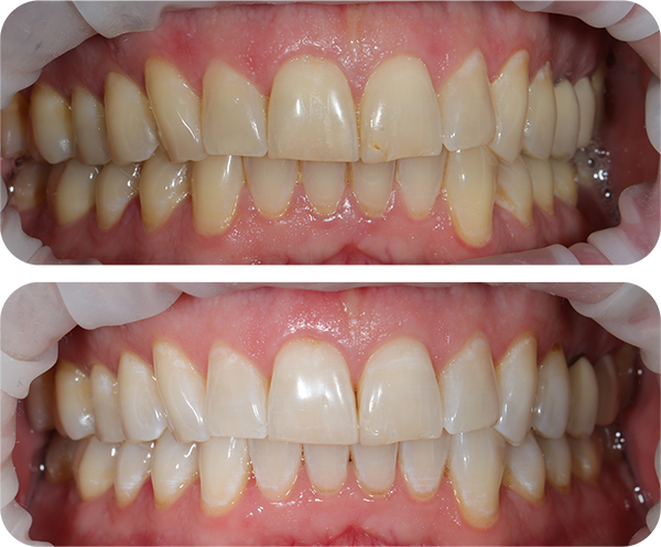 Whitening Before and After 2