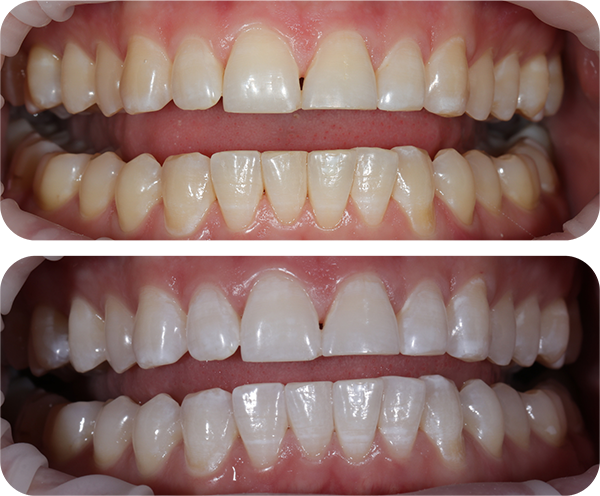 Whitening Before and After 3