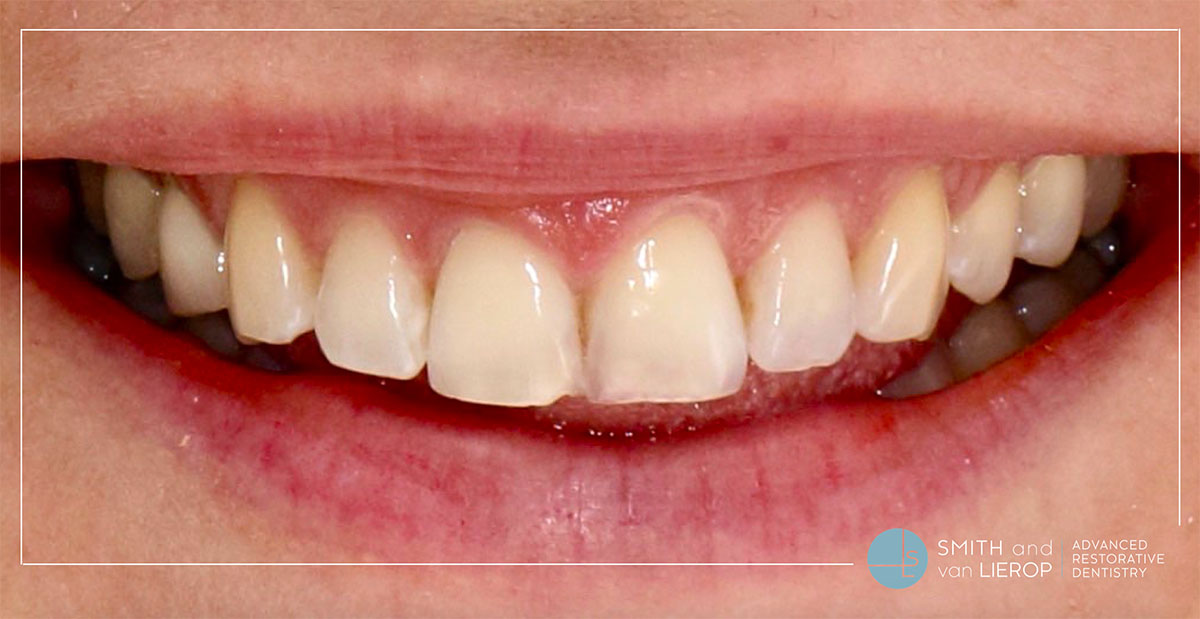 49+ How Much Is It To Whiten Teeth Images - How Long Does It Take To Whiten Teeth At Dentist
