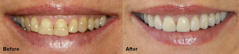 Porcelain Veneers