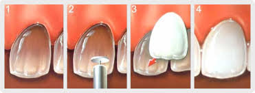 Veneers