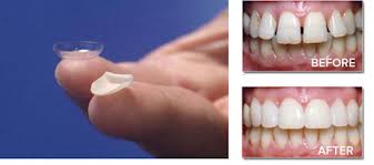 Composite Veneers