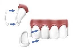 Porcelain Veneers