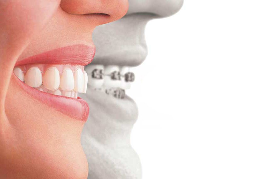 Cape Town Why Invisalign